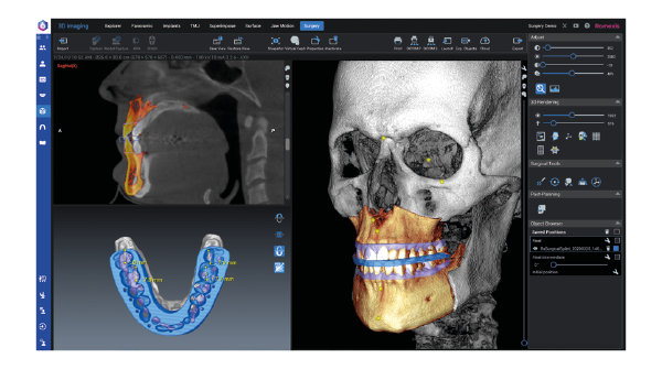 Romexis CMF surgery