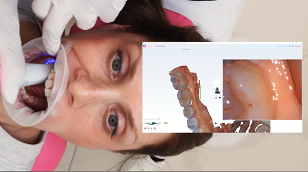 Master scanning with Planmeca Emerald intraoral scanners