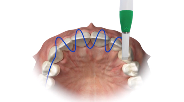 Planmeca Emerald intraoral scanners